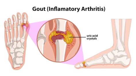 5 Common Causes of Gout in The Ankle | District Foot & Ankle