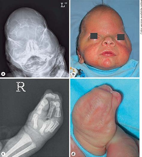 Figure 4 from Prenatal Diagnosis of Apert Syndrome with Cloverleaf Skull Deformity Using ...