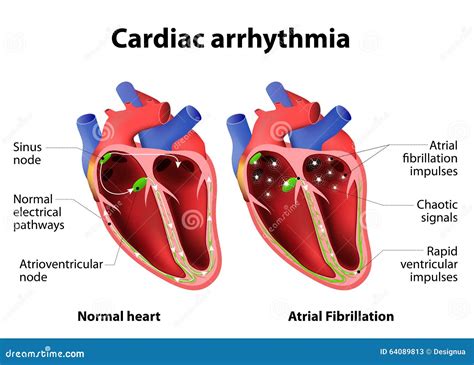 Arrhythmia Cartoons, Illustrations & Vector Stock Images - 2175 Pictures to download from ...