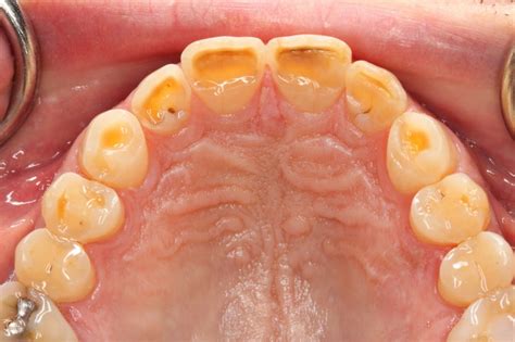 What are wear facets on teeth? | News | Dentagama