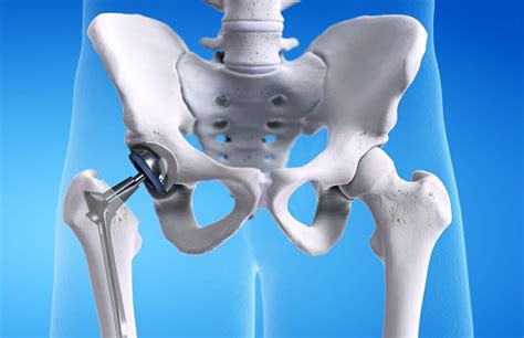 What Your Hip Replacement Implants Are Made Of · Health Vantis