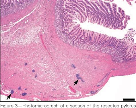 Gastroduodenostomy Procedure