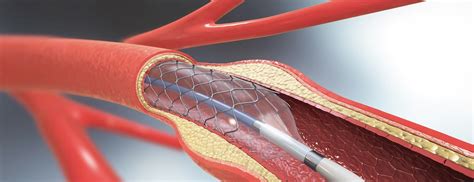 Angioplasty and Stent Placement for the Heart | Johns Hopkins Medicine