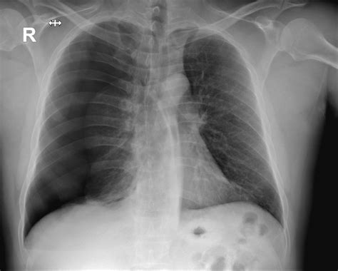 Pneumothorax Chest X Ray