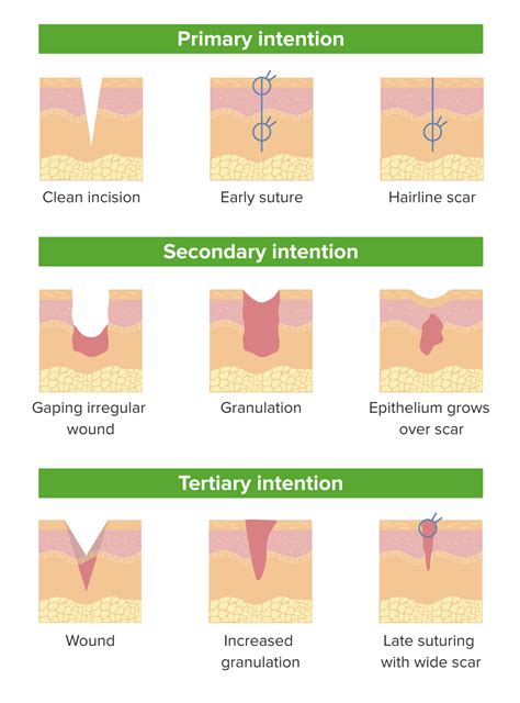 Wound Healing | Concise Medical Knowledge