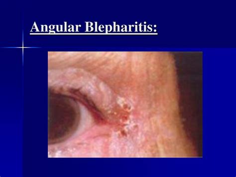 PPT - Posterior Blepharitis PowerPoint Presentation - ID:3336265