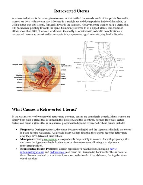 Retroverted Uterus What Causes a Retroverted Uterus? - DocsLib