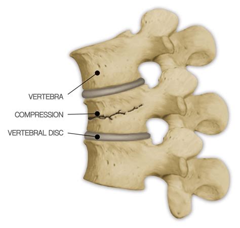 Compression Fractures - Healthy Kansas City