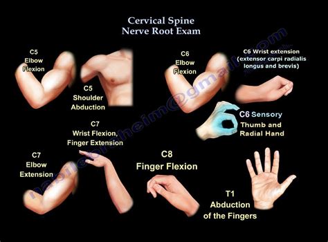 C5 c6 cervical radiculopathy pinched nerve stretches exercises – Artofit