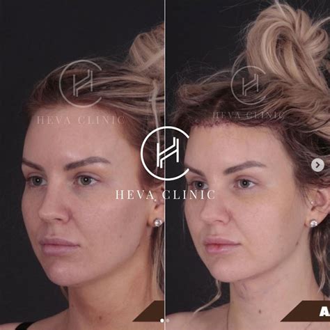 Forehead Reduction (Hairline Lowering) in Turkey - Costs in 2025 - Heva ...