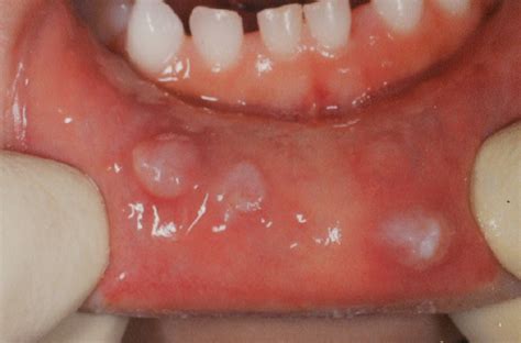 Multiple mucoceles of the lower lip: A case report - Abe - 2019 ...