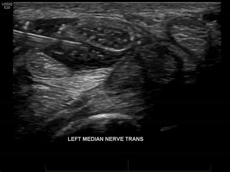 CT Guided Nerve Root Injection Melbourne