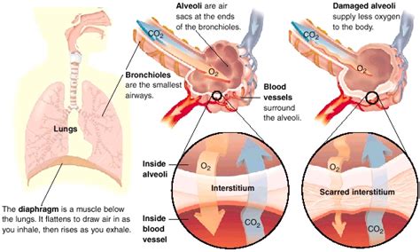 World Diseases Treatment: Lung Diseases Affecting Blood Vessels