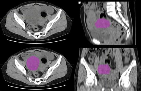 Frontiers | Preoperative Prediction of Metastasis for Ovarian Cancer Based on Computed ...