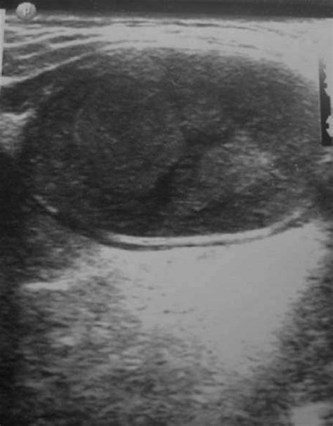 Subcutaneous Dermoid Cyst Ultrasound