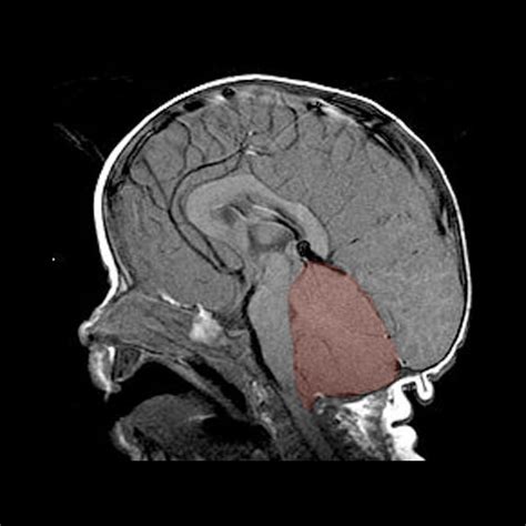 Syndrome Description: Brain | M-CM Network