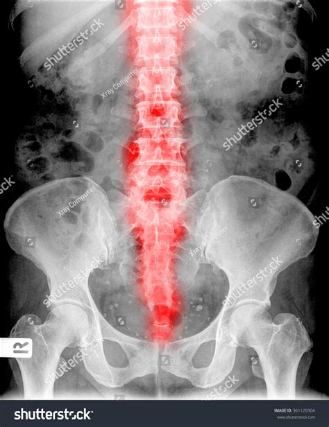 Xray Image View Backbone Men Medical Stock Photo 361129304 | Shutterstock