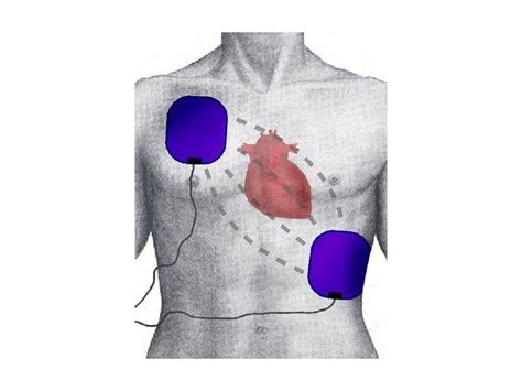 Portable Defibrillator With Step by Step Guide