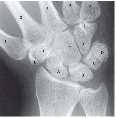 Radial deviation wrist anatomy Diagram | Quizlet