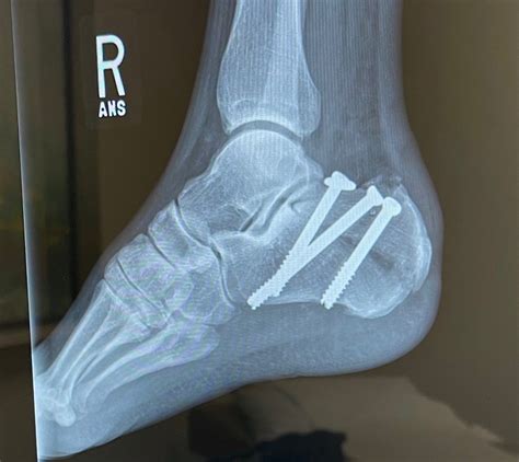 Tongue-Type Calcaneal Fracture Image 4 Unannotated - JETem