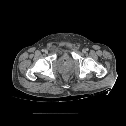 Urinary tract infection | Radiology Reference Article | Radiopaedia.org