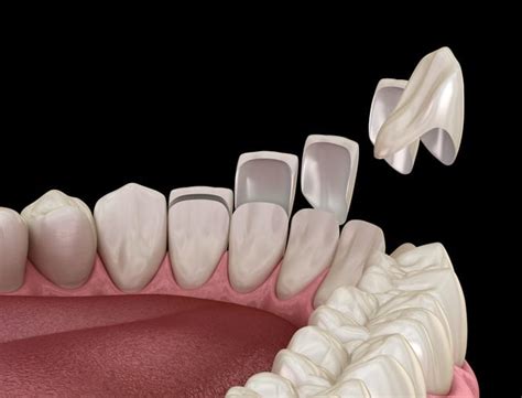 Partial and Full Porcelain Veneers by Hancock and Johnston Dentistry