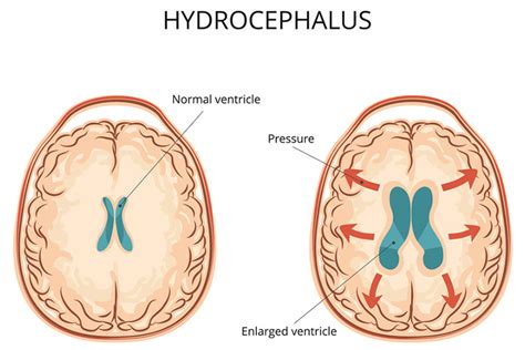 Hydrocephalus and Shunts | Ausmed