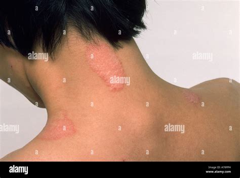 Lichen simplex chronicus Stock Photo - Alamy