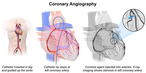 Coronary Artery Disease Evidence: Diet, Exercise | eHealthStar