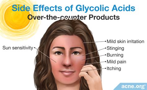 How Glycolic Acid Helps with Acne - Acne.org