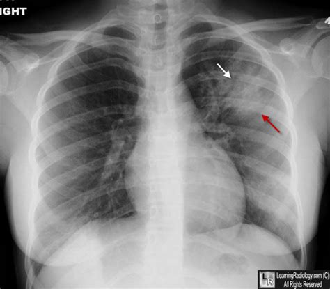 Learning Radiology - Left Upper Lobe, pneumonia