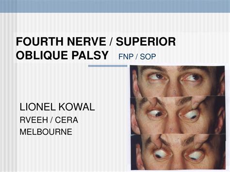 Inferior Oblique Palsy