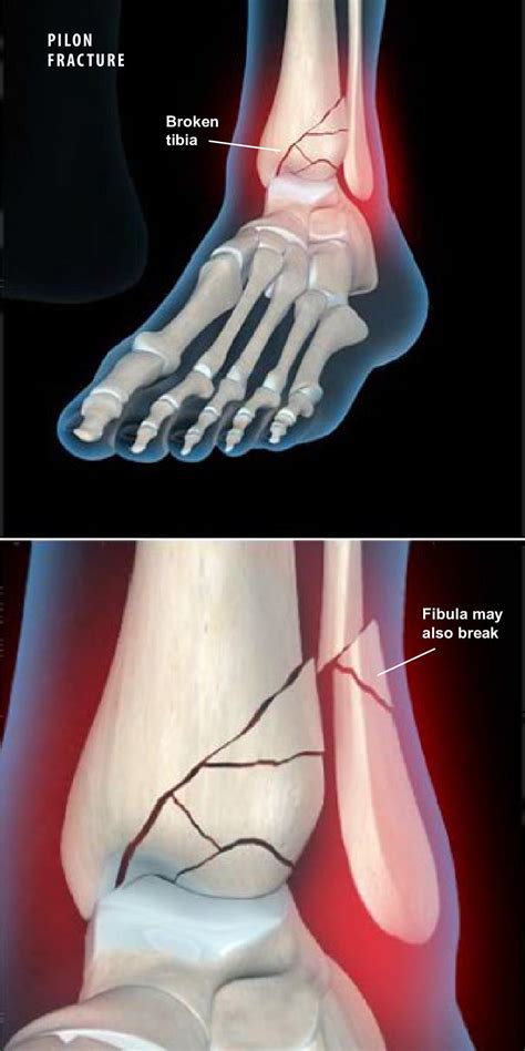 Fractura De Talon