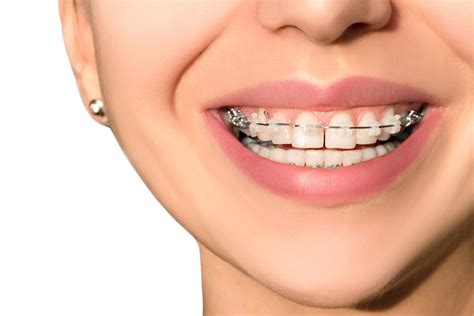 Adult Orthodontics: Is It Too Late To Get Braces? | Best Health Magazine Canada