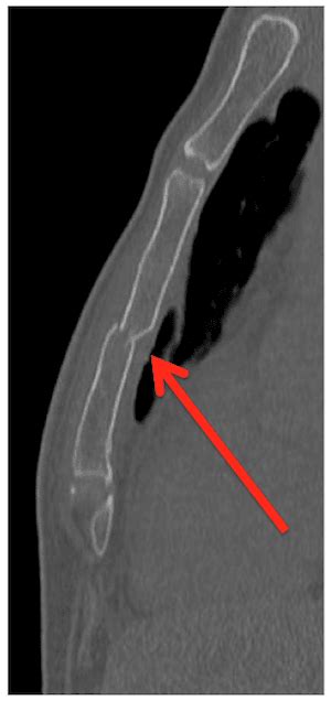 Should We Admit All Patients with Sternal Fractures?