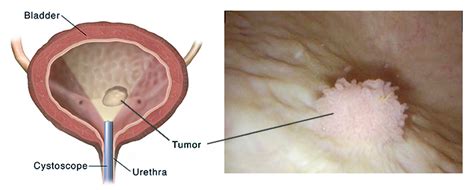 Bladder Cancer: Causes, Signs, Symptoms, Diagnosis and Stages | Saint ...