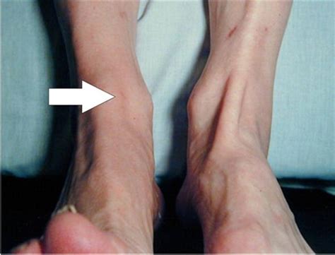 Anterior Tibialis Tendon Rupture - Foot & Ankle - Orthobullets