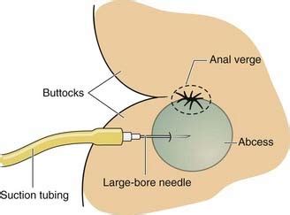 Perianal Abscess Incision and Drainage | Basicmedical Key