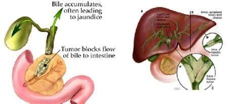 Bile Duct Cancer - Symptoms, Life Expectancy, Prognosis