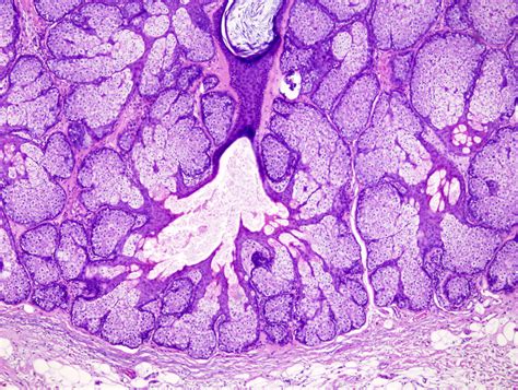 Pathology Outlines - Sebaceous hyperplasia