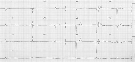 Hyperkalaemia ECG changes • LITFL • ECG Library