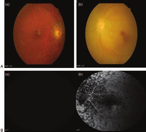 (A) Fundus photographs from the patient's initial visit. (a) The right ...