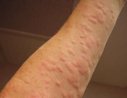 Remedy for Hives – Medical Symptoms Guide