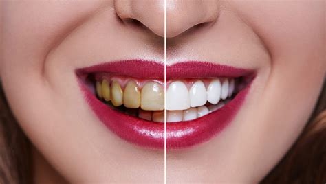 What happens to your teeth under veneers? - My Imperial Care