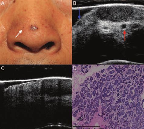 Micro-nodular basal cell carcinoma. Clinical (A), ultrasonographic (B ...