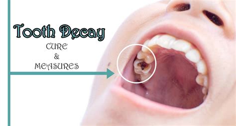 9 Tips To Cure Tooth Decay And Measures | 99 Health Ideas