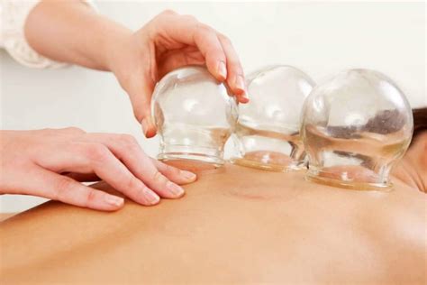 Cupping - Alliance Wellness Centre