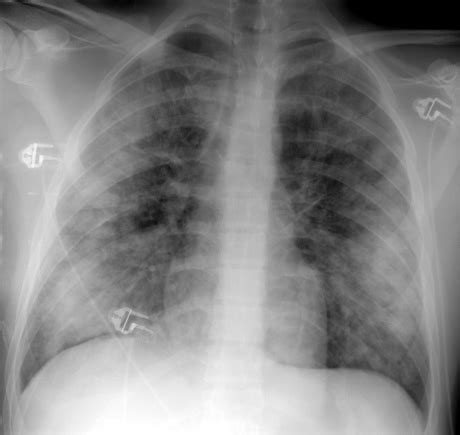 Small acute eosinophilic pneumonia.JPG (41435 bytes)