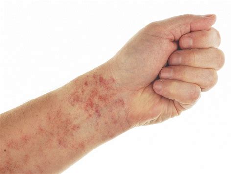 Petechiae: Causes, Treatments, Pictures, and More