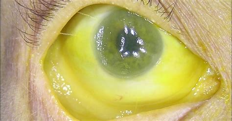 What is Scleral Icterus - Definiton, Symptoms, Causes, Treatment ...